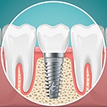 dental implant post in the jawbone