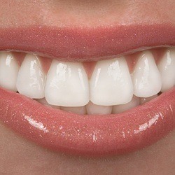 Close up smile after full-mouth dental restoration