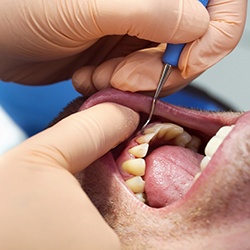 Patient receiving deep teeth cleaning periodontal therapy