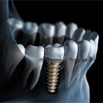 Digital illustration of dental implant bridge in Grapevine