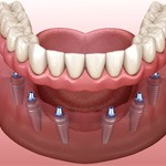 Digital illustration of dental implant dentures in Grapevine