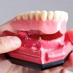 Model implant denture