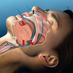 Dental appliance shop for sleep apnea
