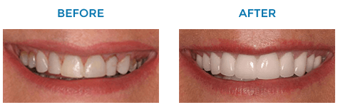 Before and after porcelain veneers