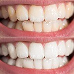 Smile before and after teeth whitening