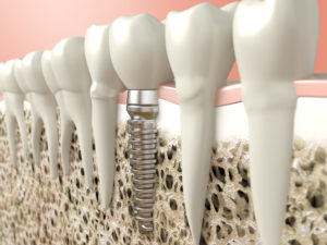 Dental implant graphic