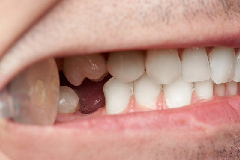 Dental mirror showing patient's missing back tooth