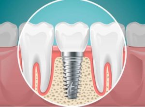 Dental implant replacing a molar