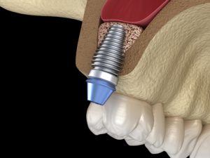 Model of dental implant in jawbone