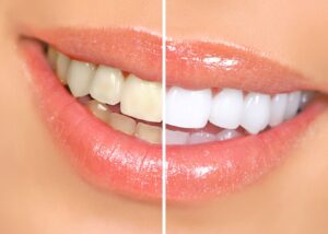 Closeup of a smile that's half whitened